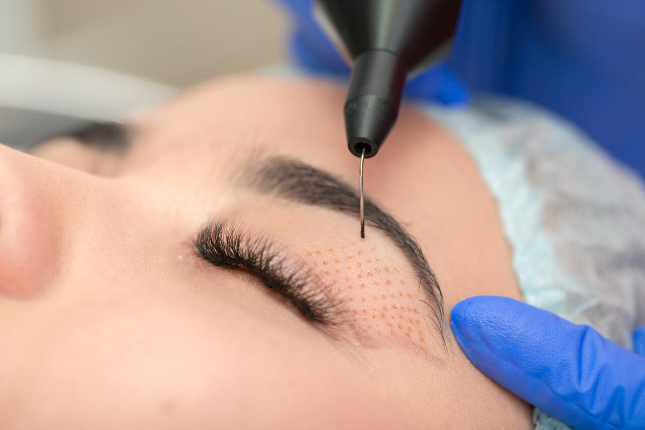 Plasma Pen Behandlung