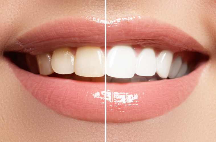 Zahnbleaching Vorher-Nachher Vergleich - Sonstige Beauty-Leistungen